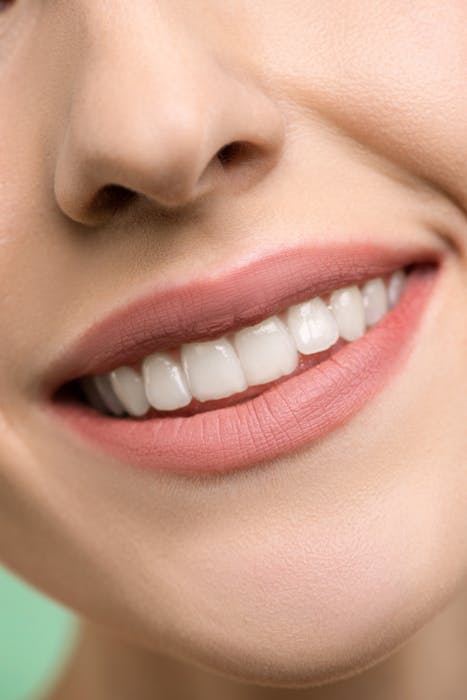 Ceramic veneers